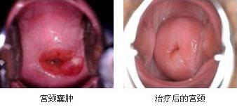 杭州治疗宫颈囊肿好的医院是哪家